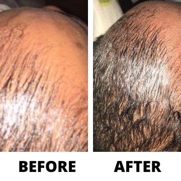 Three Bottles of Rennora EXTRA-Strength Hair Growth Serum - Image 2