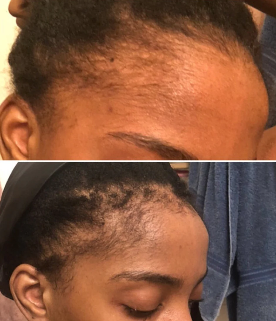 Three Bottles of Rennora EXTRA-Strength Hair Growth Serum - Image 6