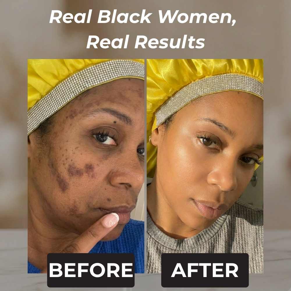 Rennora Dark Spot Remover - Image 3