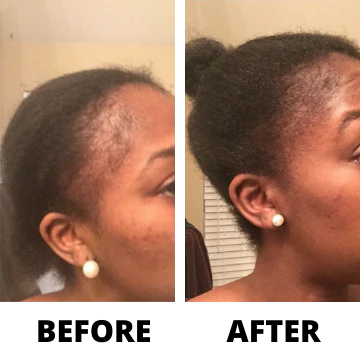 Rennora EXTRA-Strength Hair Growth Serum - Image 3